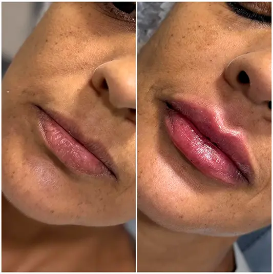 Harmonização Facial