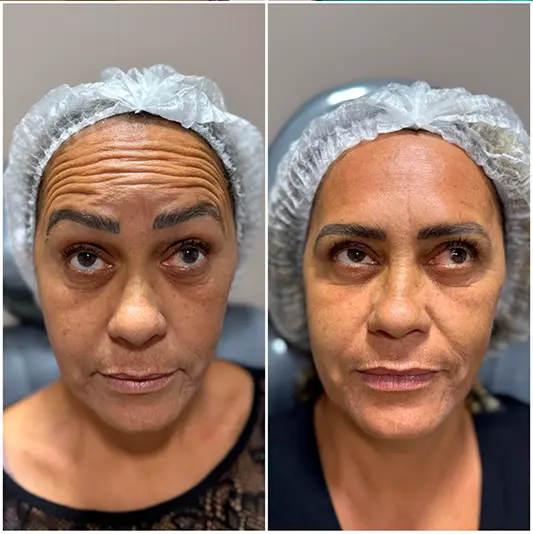 Botox