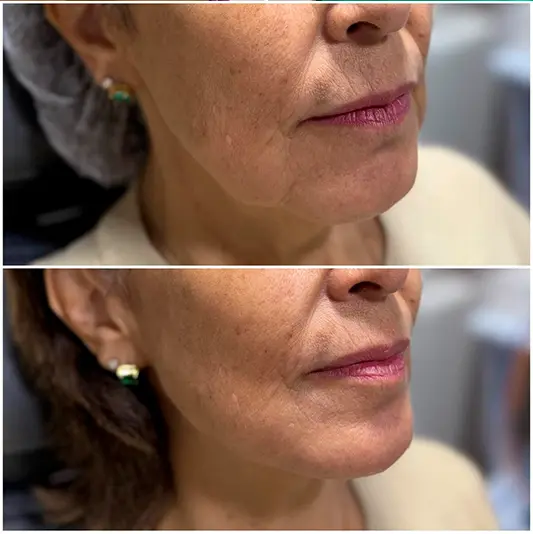 Bioestimulador de Colágeno
