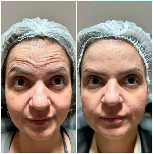 Botox